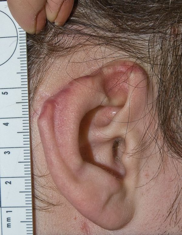 ear defect-0061934.jpg